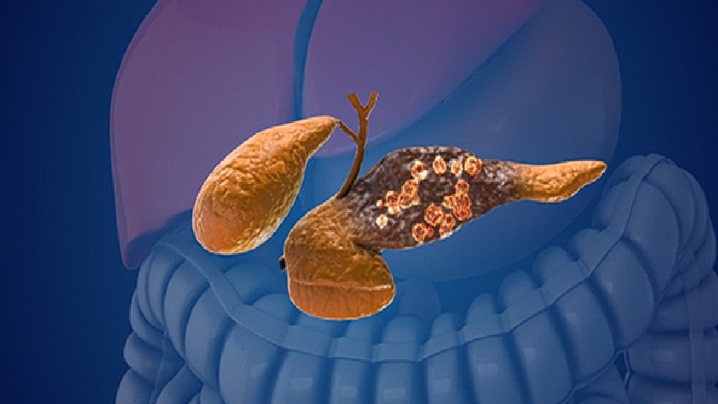 Mayo Clinic AI Detects Pancreatic Cancer Years Before Diagnosis